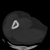SPORK, NICO - 22.03.1976 - 02.08.2022 - CT obere Extremität - 17:59:38
